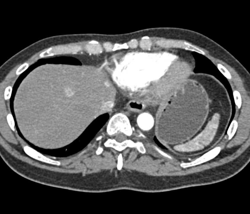 Focal Nodular Hyperplasia - CTisus CT Scan