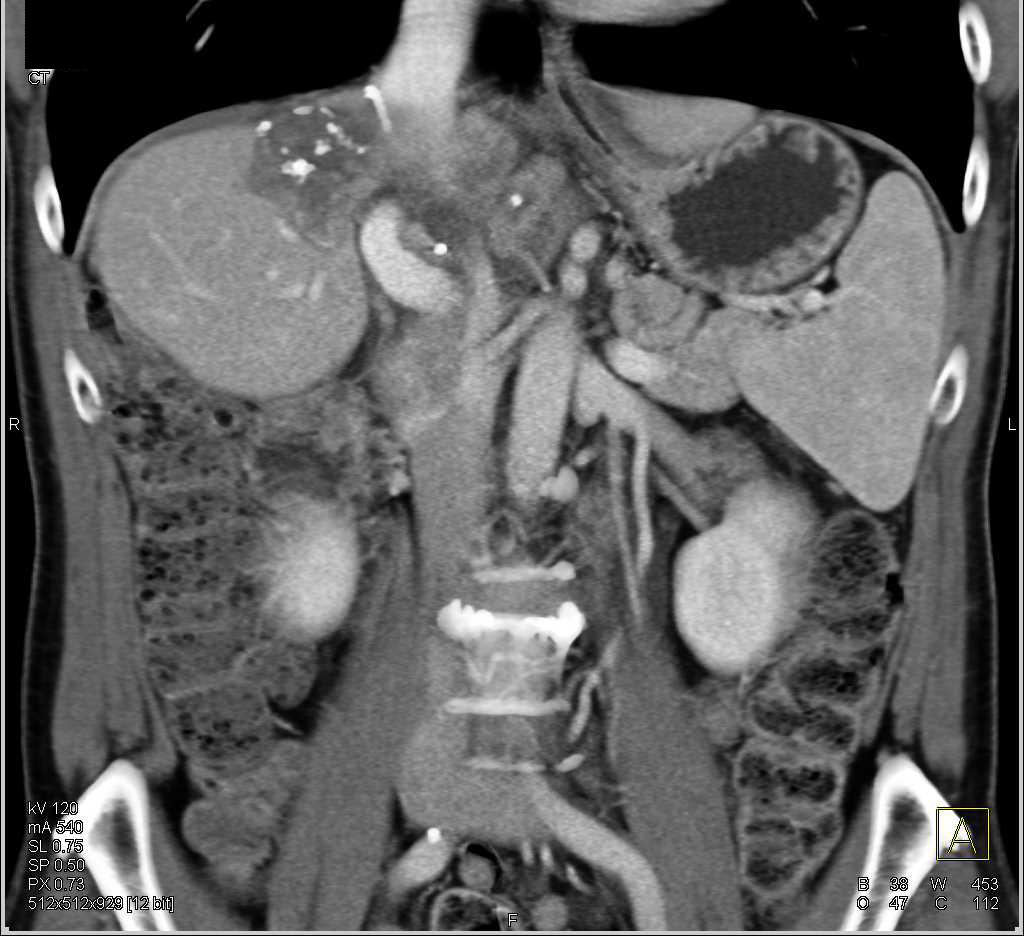 Recurrent Hepatocellular Carcinoma (Hepatoma) at Resection Site - CTisus CT Scan