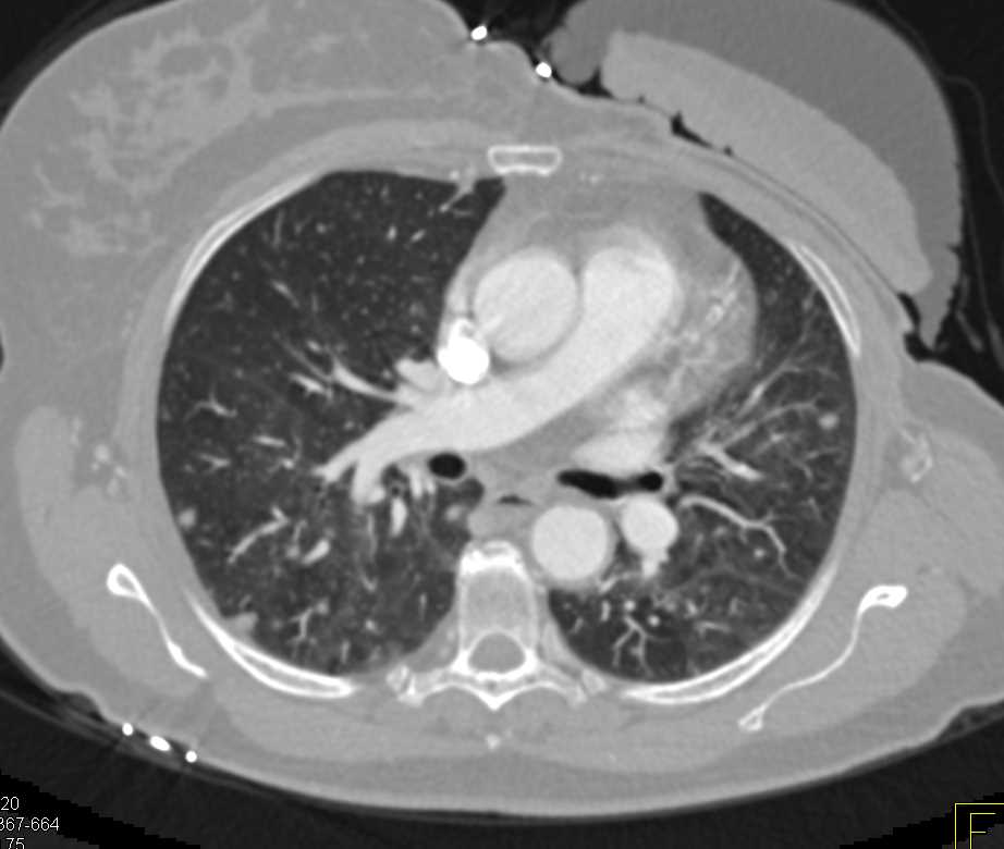 Breast Cancer with Liver Metastases and Incidental Cystic Pancreatic Mass - CTisus CT Scan