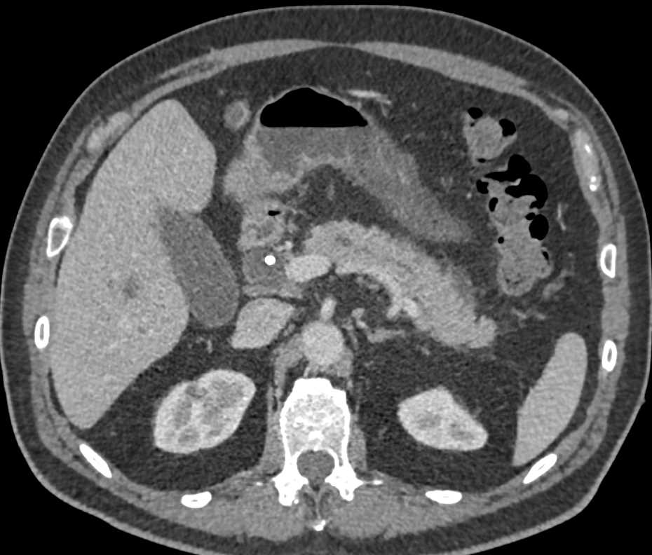 Ampullary Carcinoma - Liver Case Studies - CTisus CT Scanning