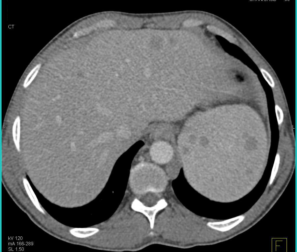 Lymphoma Involves the Liver, Spleen and Lymph Nodes - CTisus CT Scan