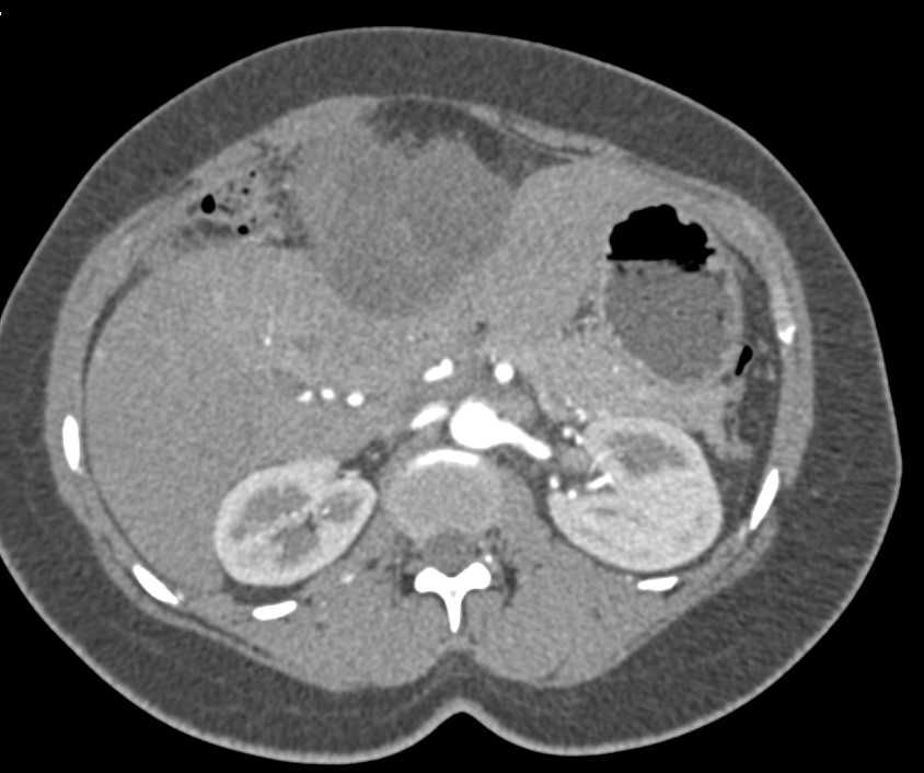 Cystic Metastases from Sarcoma on the Liver Surface - CTisus CT Scan