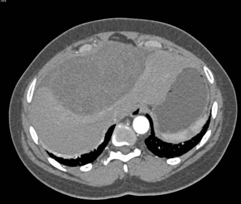 Cystic Metastases from Sarcoma on the Liver Surface - CTisus CT Scan