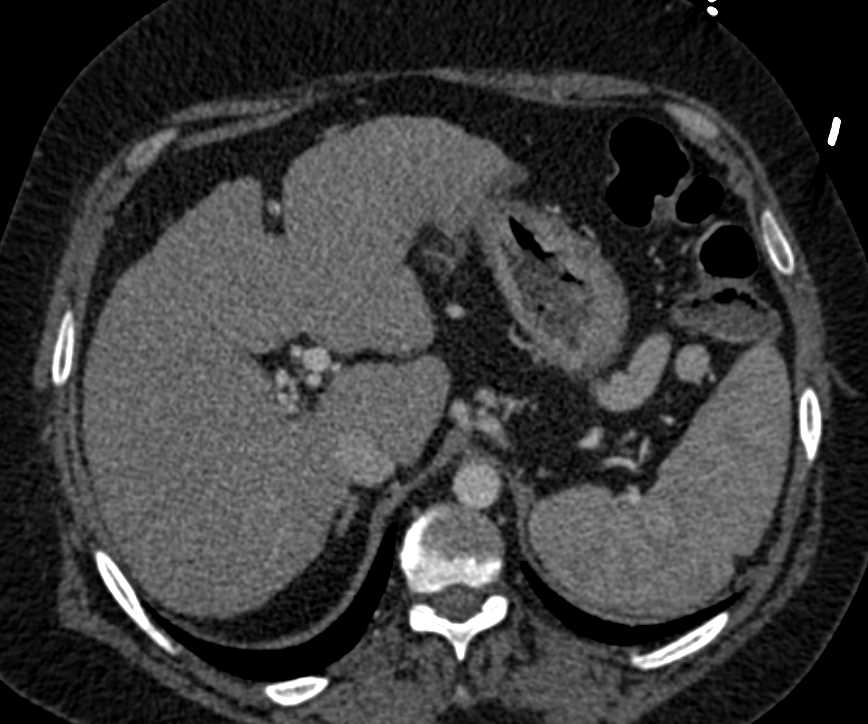 Cirrhosis with Varices and Portal Hypertension - CTisus CT Scan