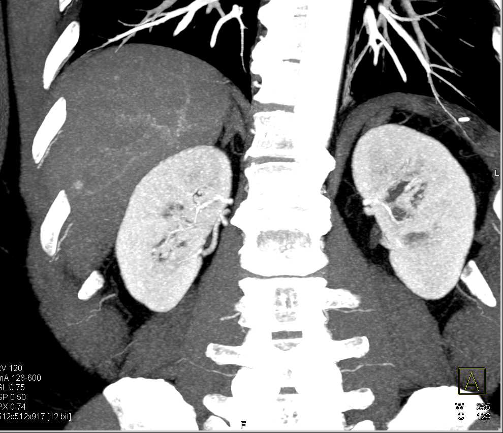 Multiple Small Vascular Liver Lesions - CTisus CT Scan