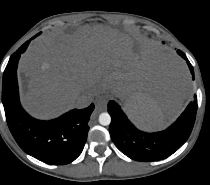 Hepatocellular Carcinoma (Hepatoma) Arises in Cirrhotic Liver - CTisus CT Scan