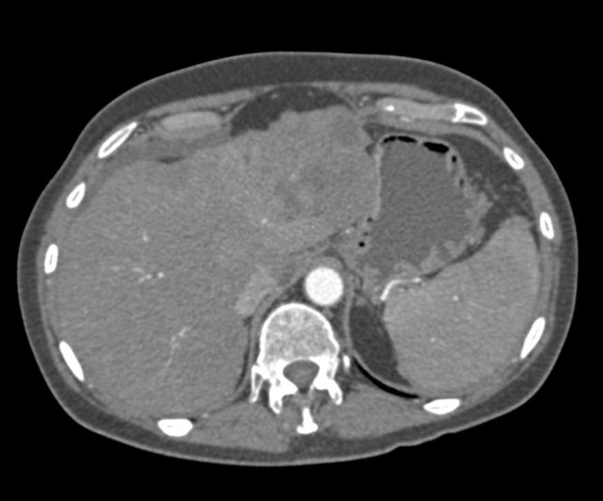 Multifocal Hepatocellular Carcinoma (Hepatoma) - CTisus CT Scan