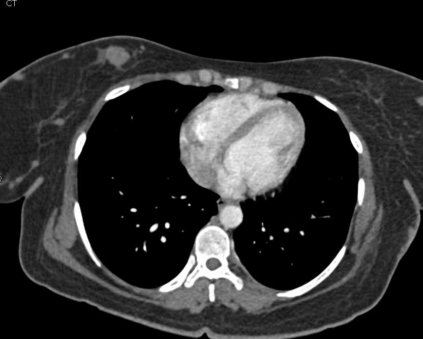 Simultaneous Right Breast and Pancreatic Cancer with Liver Metastases - CTisus CT Scan