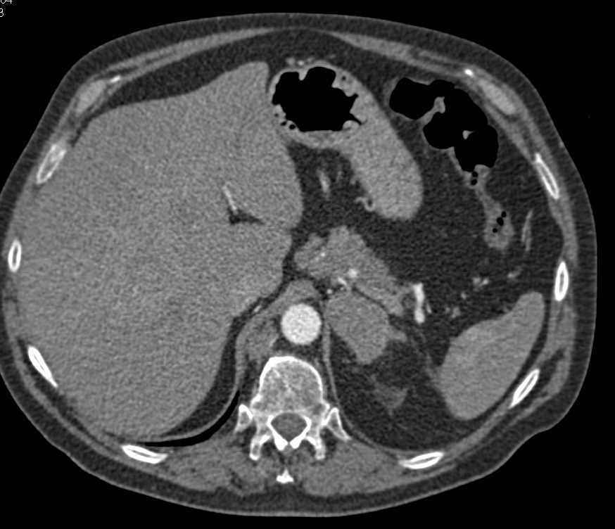 Hepatocellular Carcinoma (Hepatoma) with Left Adrenal Metastases - CTisus CT Scan