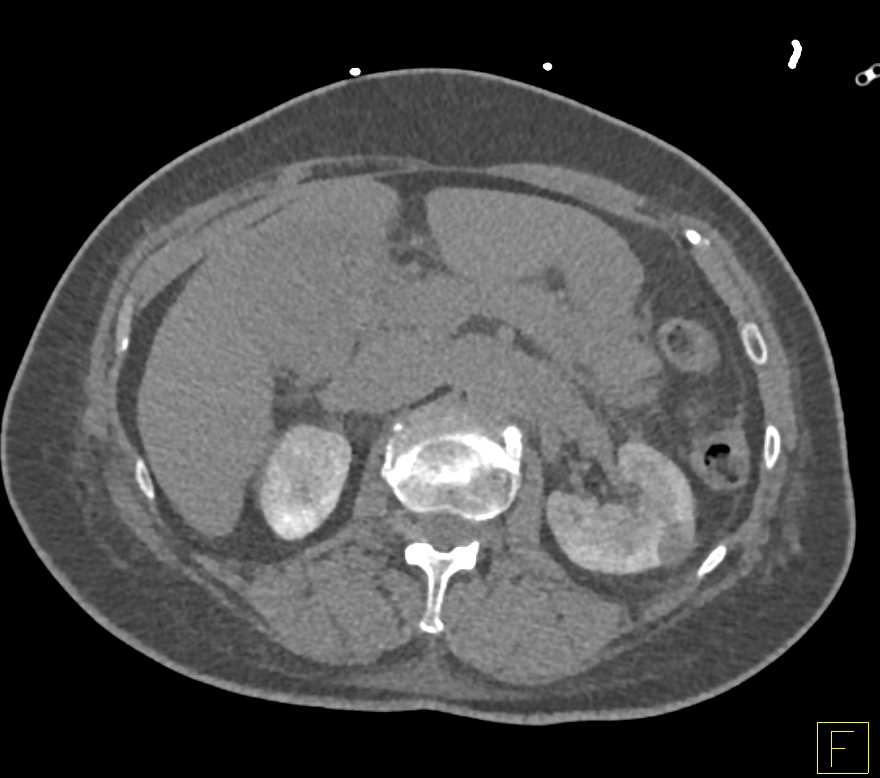 Acute Cholecystitis and Acute Pyelonephritis - CTisus CT Scan