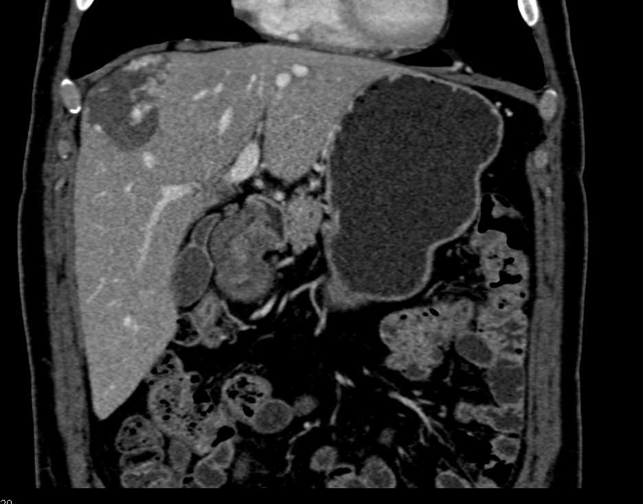 Hepatic Hemangioma - CTisus CT Scan