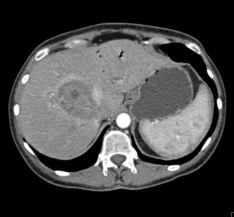 Cholangiocarcinoma with Stent - CTisus CT Scan