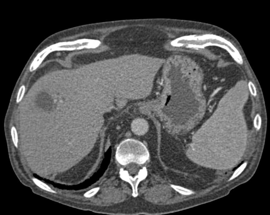 Atypical hemangioma - Liver Case Studies - CTisus CT Scanning