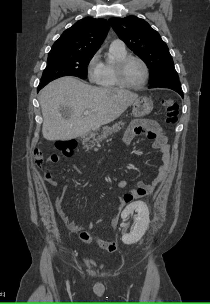 Liver Metastases from Colon Cancer - Liver Case Studies - CTisus CT