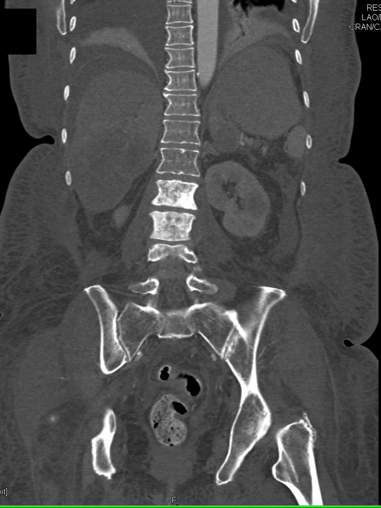 Metastatic Carcinoid Tumor with Liver and Bone Metastases - CTisus CT Scan