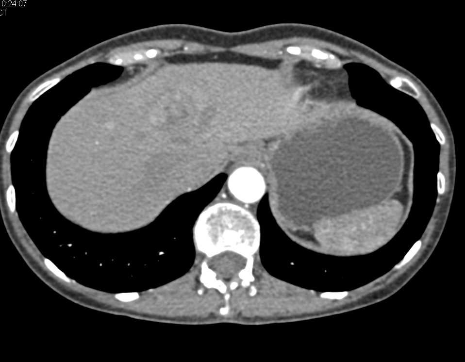 Ampullary Cancer with Liver Metastases - CTisus CT Scan