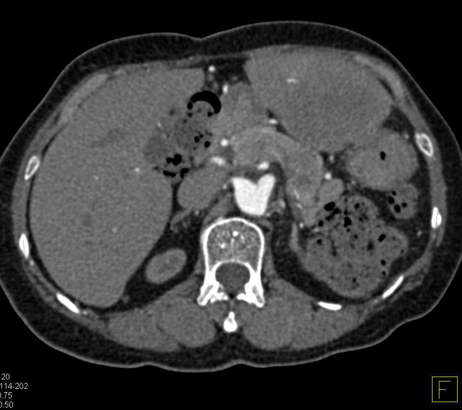 Metastatic Neuroendocrine Tumor to Liver - CTisus CT Scan