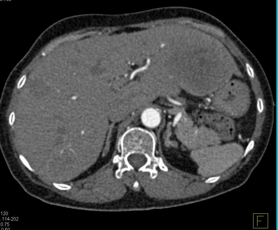 Metastatic Neuroendocrine Tumor to Liver - CTisus CT Scan