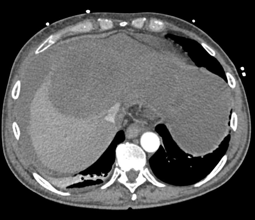 Hepatocellular Carcinoma (Hepatoma) with Active Bleed in the Liver - CTisus CT Scan