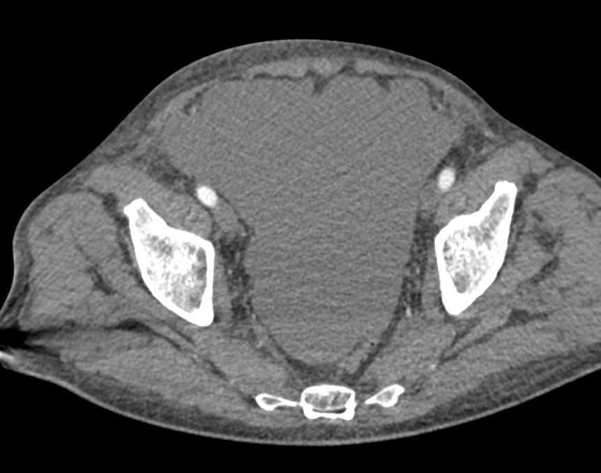 Hepatocellular Carcinoma (Hepatoma) with Active Bleed in the Liver - CTisus CT Scan