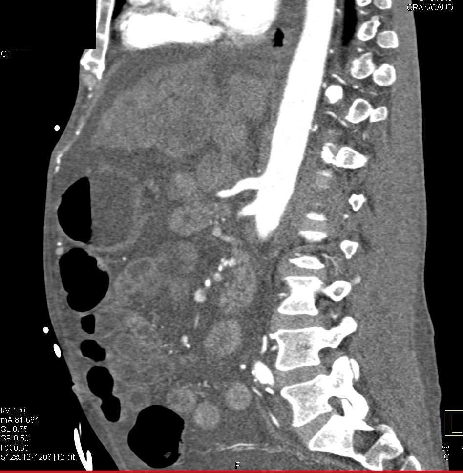 Cholangiocarcinoma with Extensive Tumor in Hilum - CTisus CT Scan