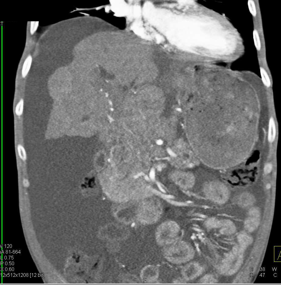 Cholangiocarcinoma with Extensive Tumor in Hilum - CTisus CT Scan