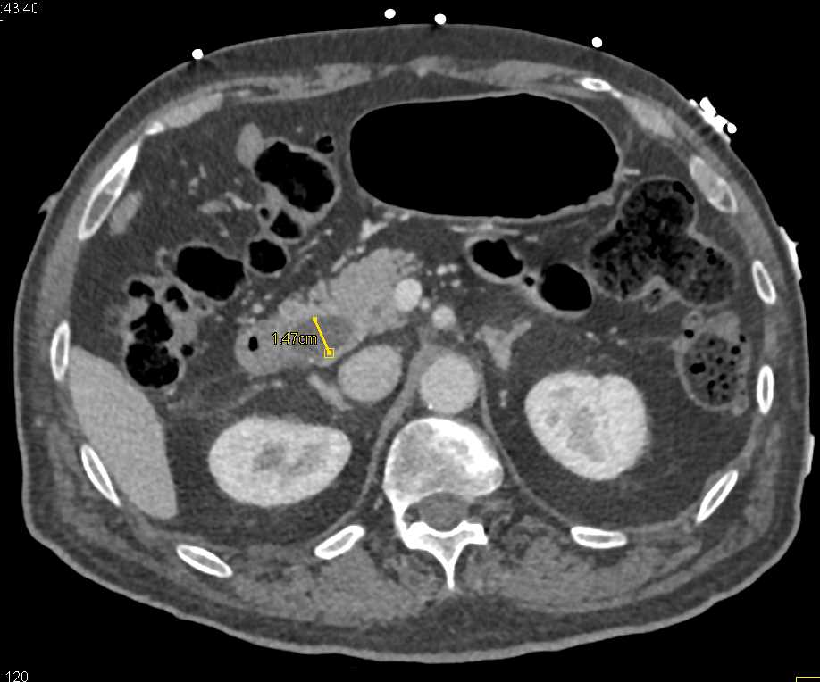 Multiple Stones in the Distal Common Bile Duct (CBD) and Gallbladder - CTisus CT Scan