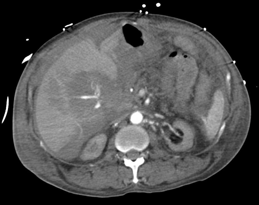 Active Bleed in the Hilum of the Liver - CTisus CT Scan