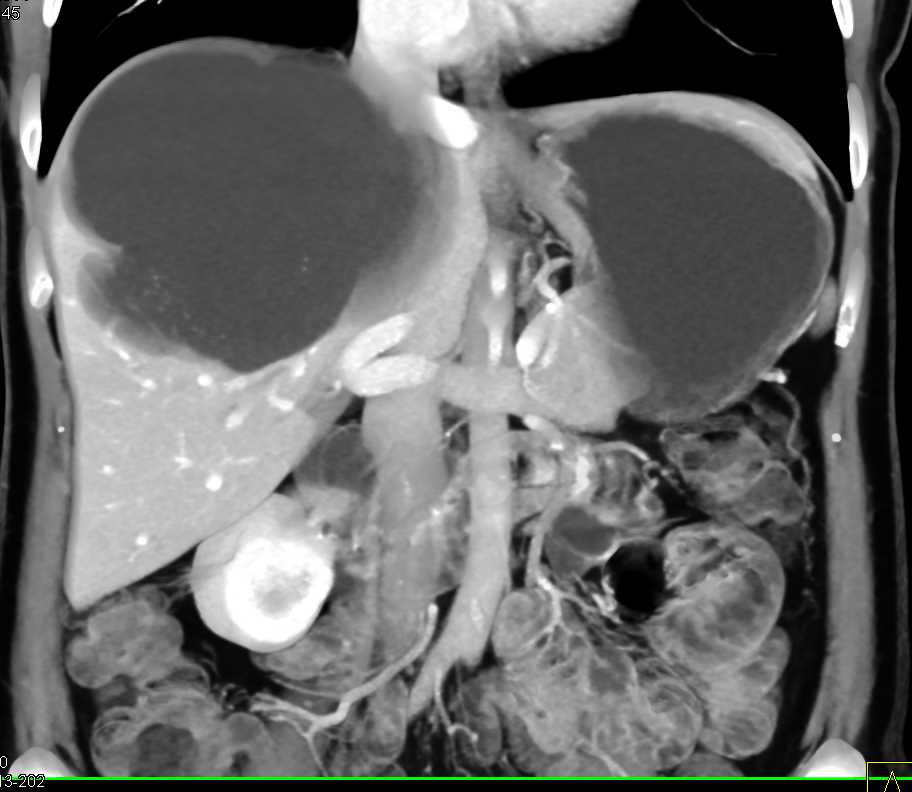 Simple Hepatic Cyst Liver Case Studies CTisus CT Scanning