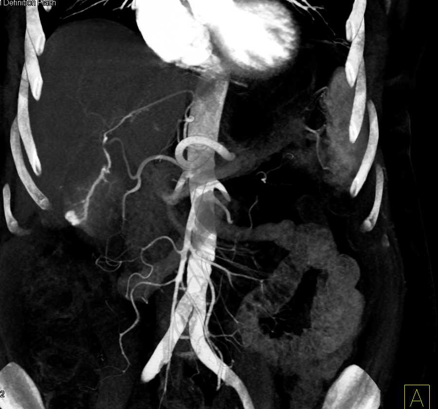 Arteriovenous (AV) Shunt in Liver can Simulate a Hepatocellular Carcinoma (Hepatoma) - CTisus CT Scan