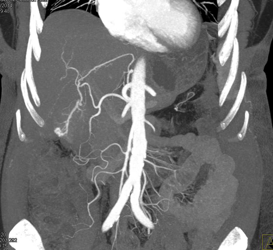 Arteriovenous (AV) Shunt in Liver can Simulate a Hepatocellular Carcinoma (Hepatoma) - CTisus CT Scan