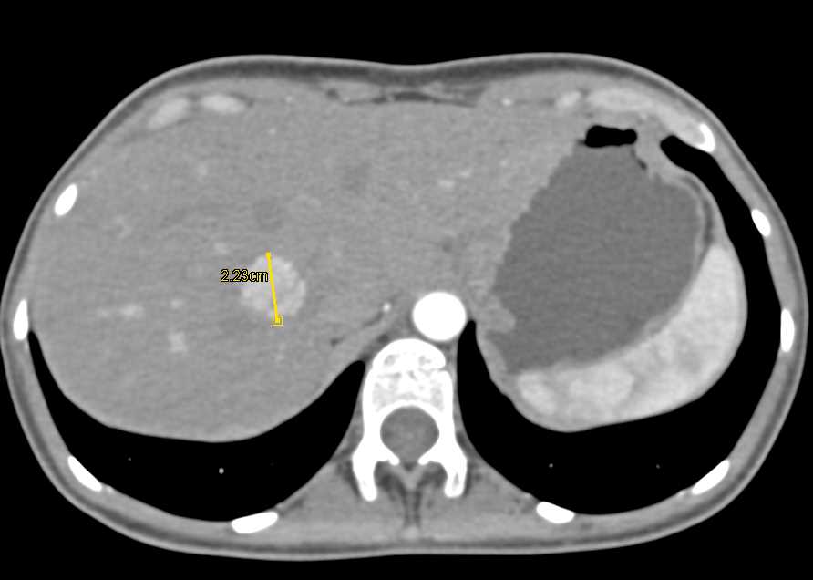 Focal Nodular Hyperplasia Liver Mass - CTisus CT Scan