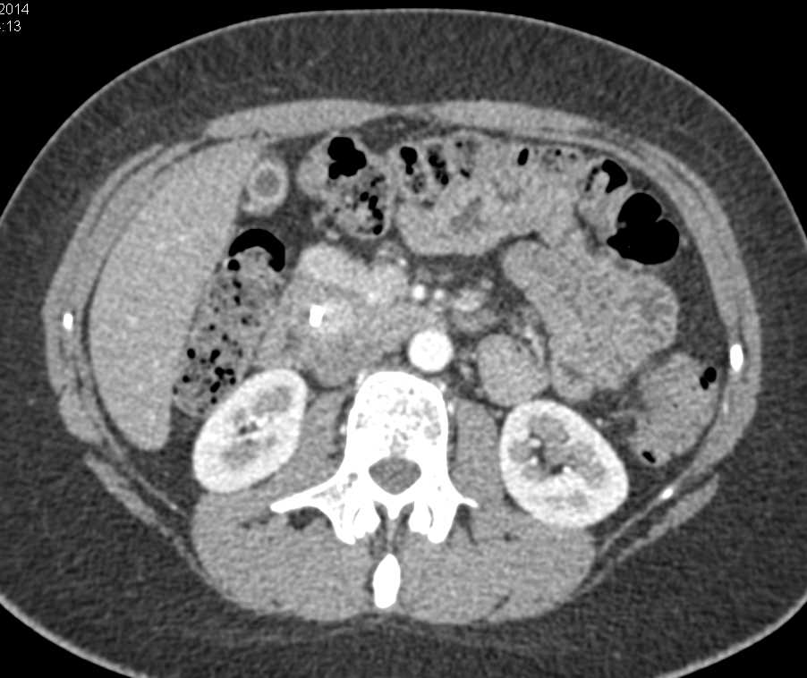 Common Duct Tumor with a Stent - CTisus CT Scan