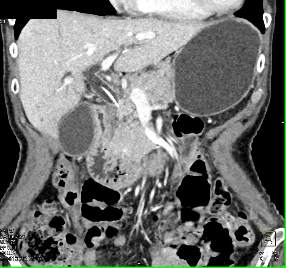 Distal Common Bile Duct Dilatation due to CBD Tumor - CTisus CT Scan