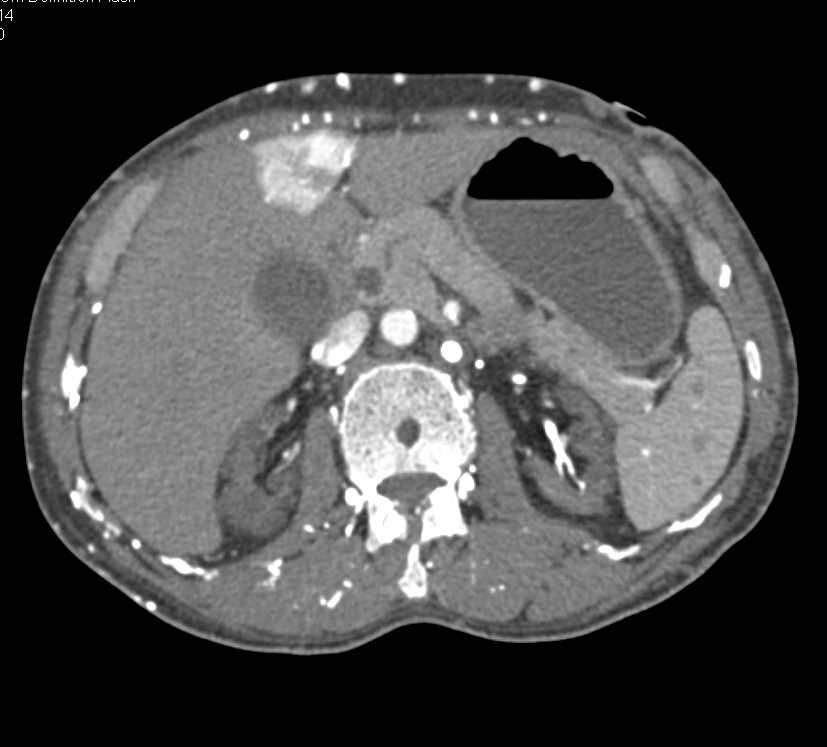 Hot Spot Liver due to Superior Vena Cava (SVC) Occlusion with Multiple Collaterals Seen - CTisus CT Scan