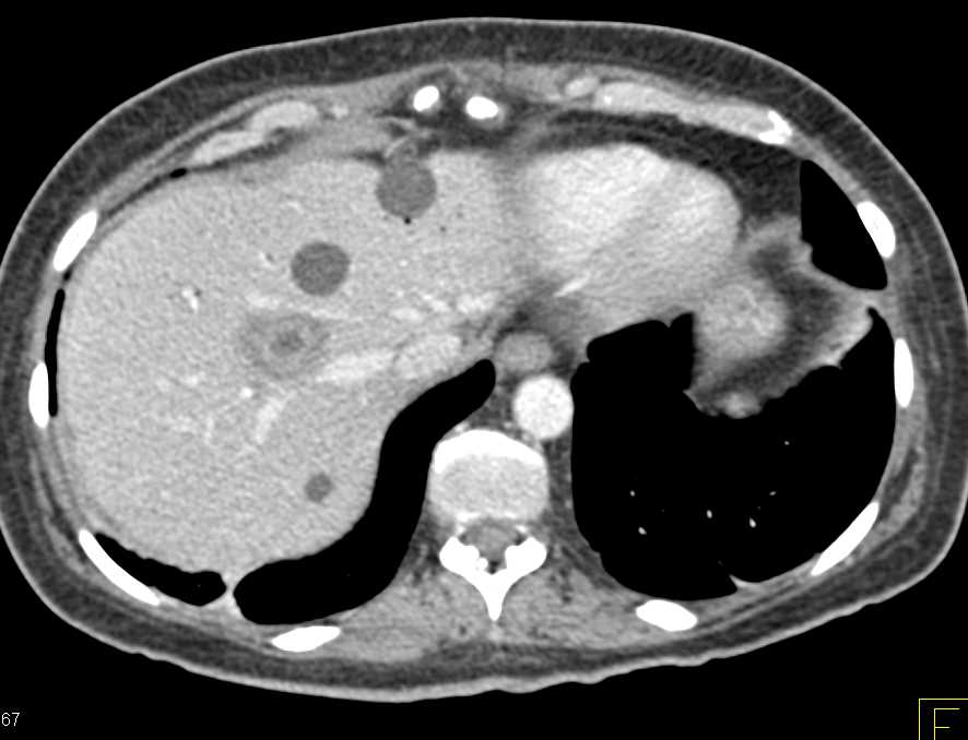 Hepatic Abscesses in Post Whipple Patient for Pancreatic Cancer Simulates Metastases with Bullseye Lesions - CTisus CT Scan