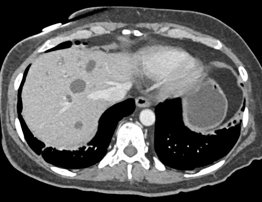 Hepatic Abscesses in Post Whipple Patient for Pancreatic Cancer