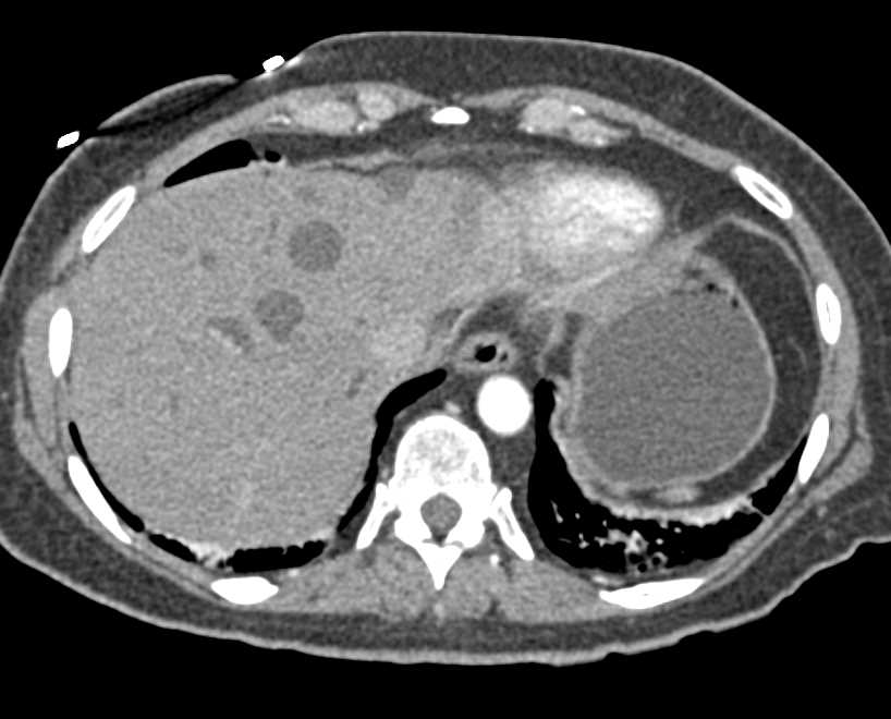 Hepatic Abscesses in Post Whipple Patient for Pancreatic Cancer Simulates Metastases with Bullseye Lesions - CTisus CT Scan