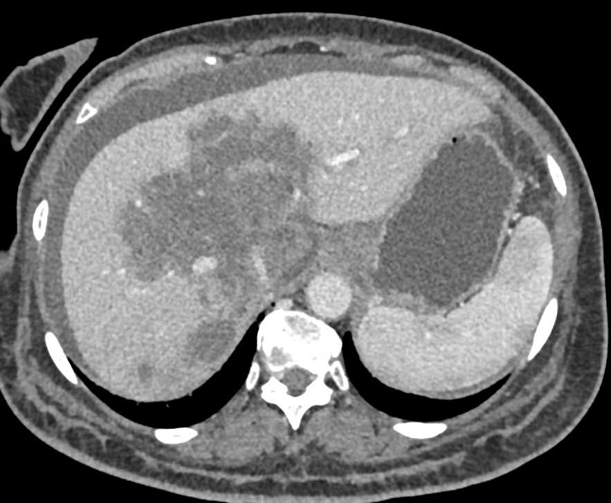 Central Cholangiocarcinoma - CTisus CT Scan