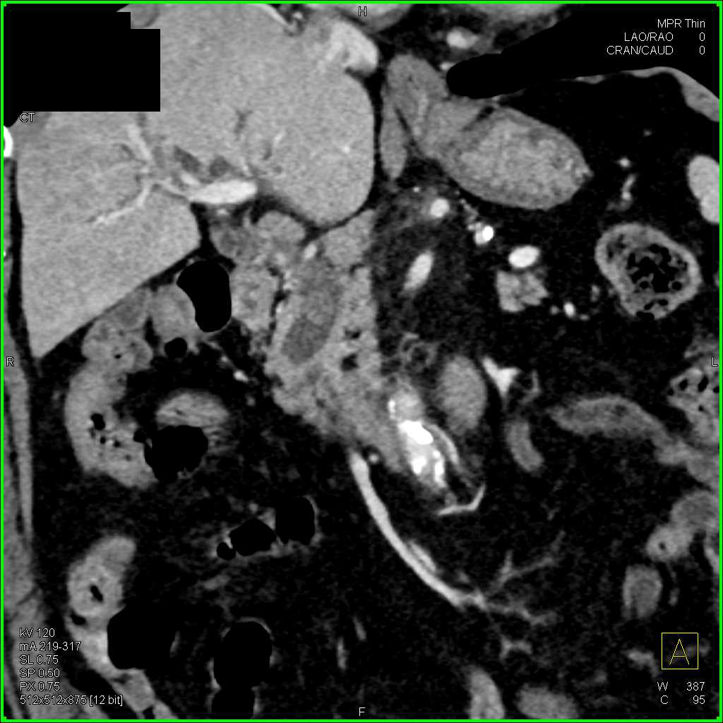 Impacted Stone in Dilated Common Bile Duct - CTisus CT Scan