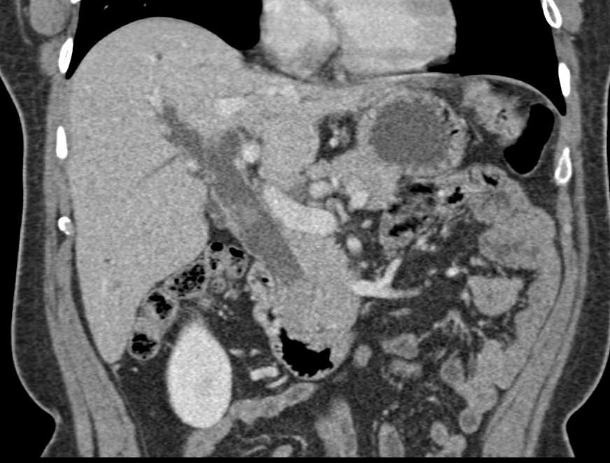 Dilated Common Bile Duct with Impacted Stone - CTisus CT Scan