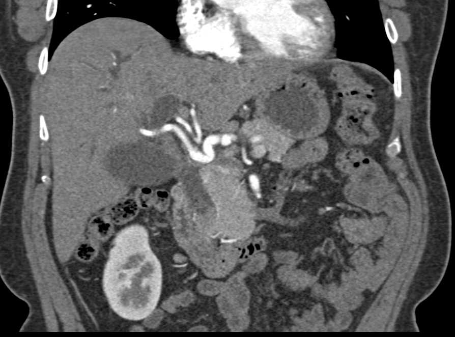 Dilated Common Bile Duct with Impacted Stone - Liver Case Studies