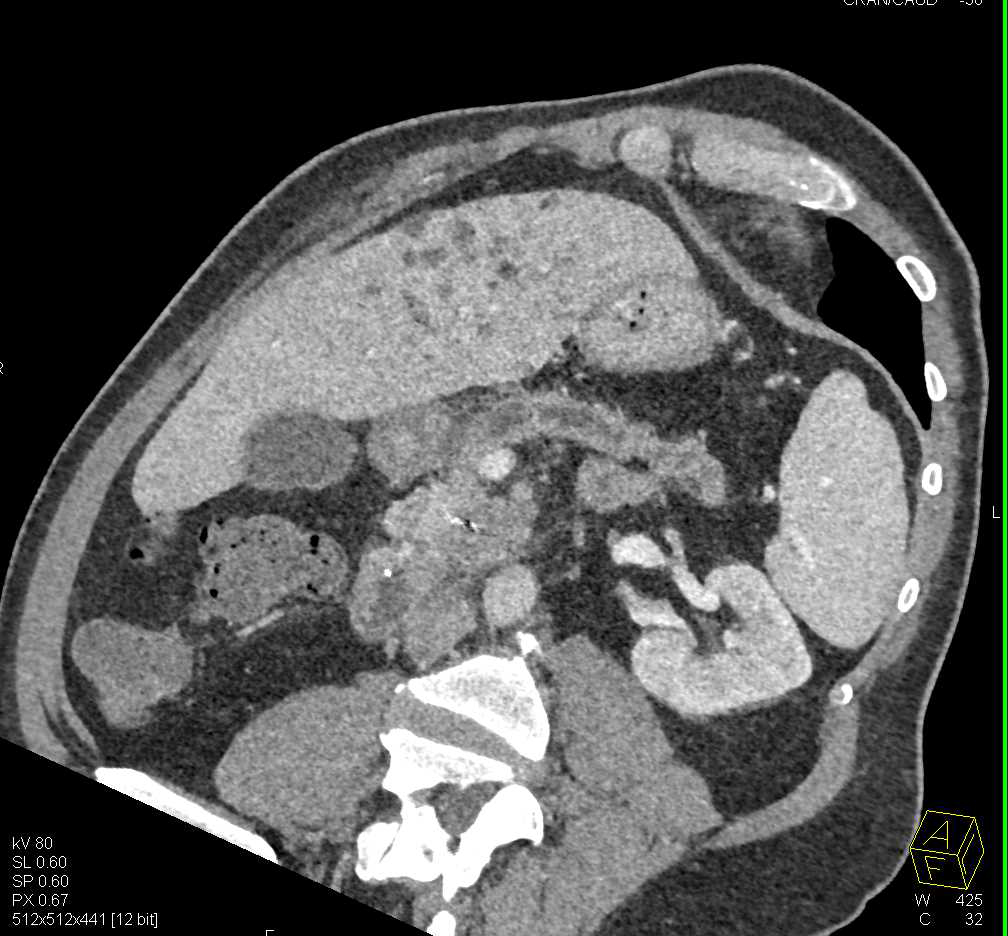 Pancreatic Cancer with Liver Metastases Liver Case