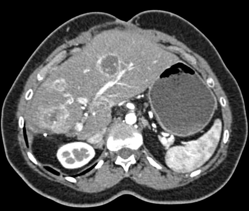 Metastatic Carcinoid Tumor with Vascular Metastases - CTisus CT Scan