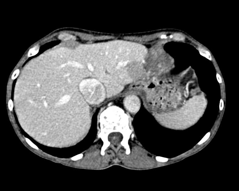 Hemangioma Left Lobe of the Liver - Liver Case Studies - CTisus CT Scanning