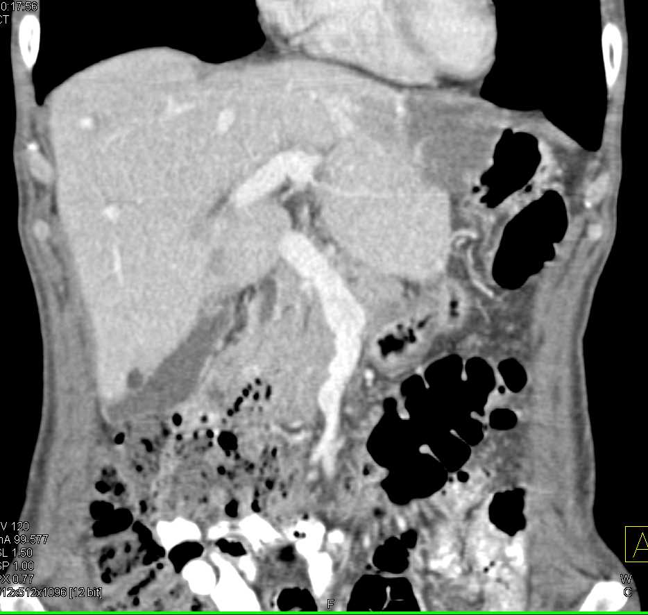 Hemangioma Left Lobe of the Liver - Liver Case Studies - CTisus CT Scanning