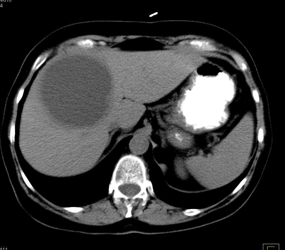 Cystic Hepatic Abscess - CTisus CT Scan