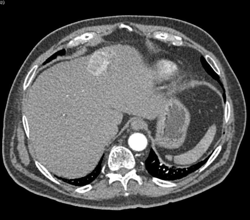 Atypical Enhancement Pattern for a Hepatocellular Carcinoma (Hepatoma) - CTisus CT Scan