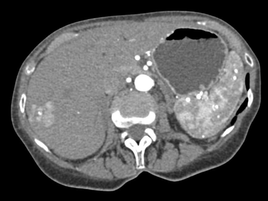 Incidental Focal Nodular Hyperplasia Right Lobe of Liver - CTisus CT Scan