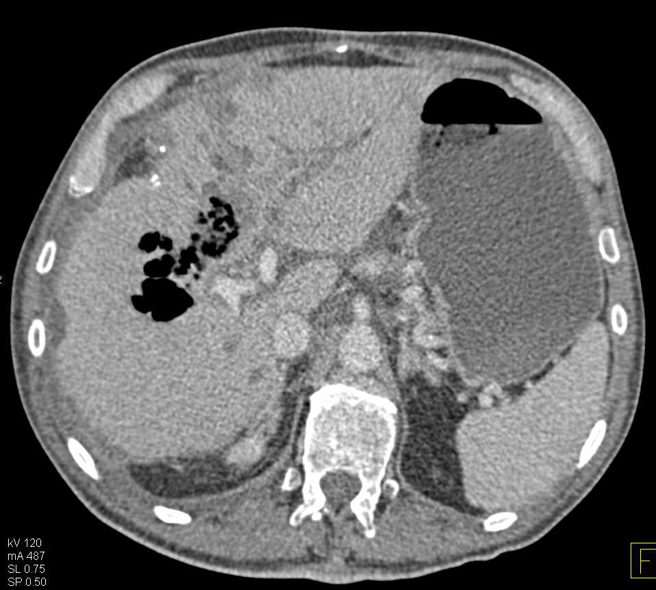 Liver Abscess - CTisus CT Scan